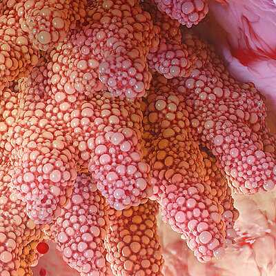Carcinoma vescicale