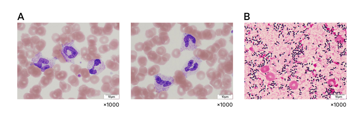 Fig. 3 (A) Lo striscio periferico del paziente mostra granulazione tossica dei neutrofili. (B) L’emocoltura (colorazione di Gram) è risultata positiva per Staphylococcus aureus.