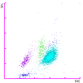 Fig. 2 Scattergramma WDF che mostra la posizione dei neutrofili spostata verso l’alto e la presenza di granulociti immaturi (blu scuro).